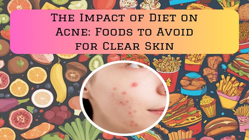 The Impact of Diet on Acne: Foods to Avoid for Clear Skin